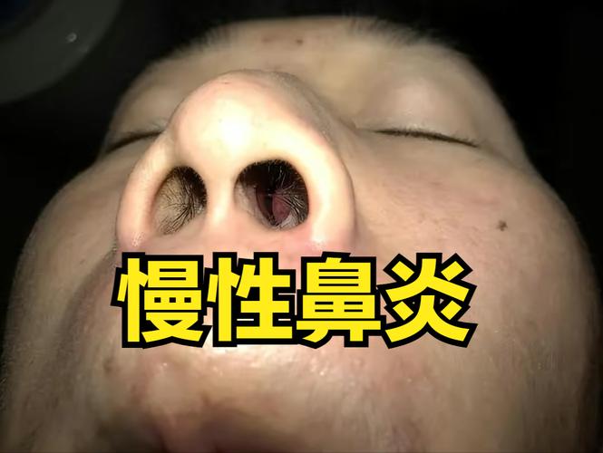 鼻炎