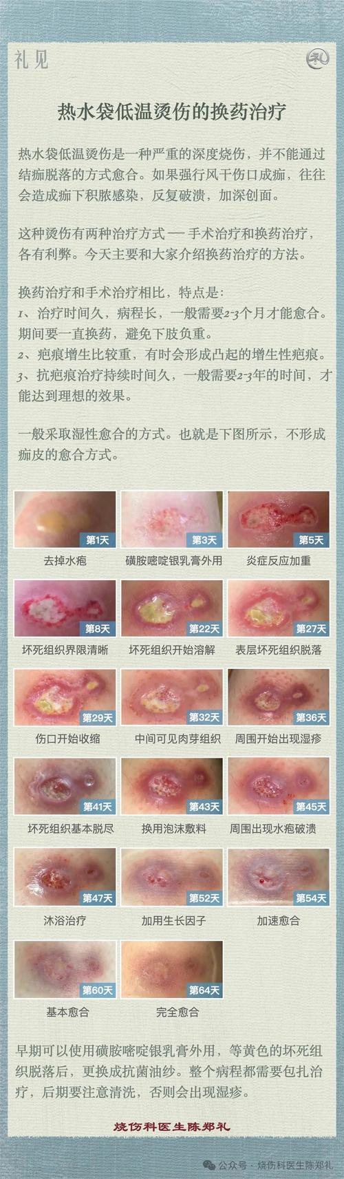 热水疗法