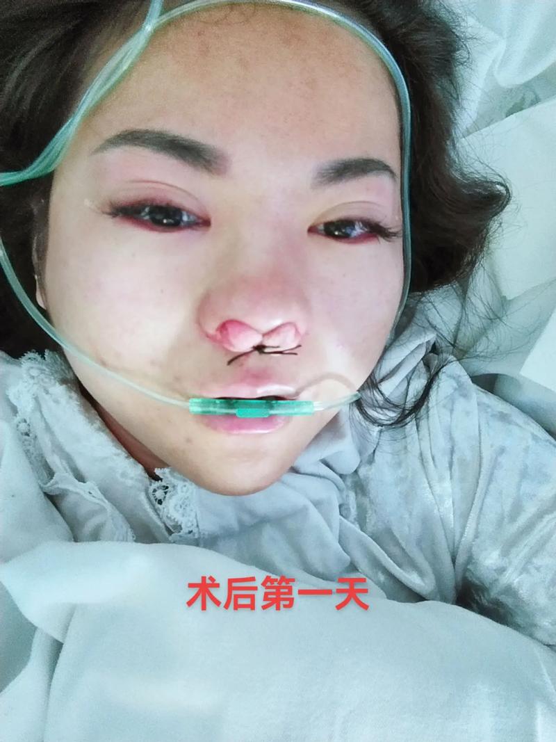 鼻内镜手术，鼻炎，治疗效果