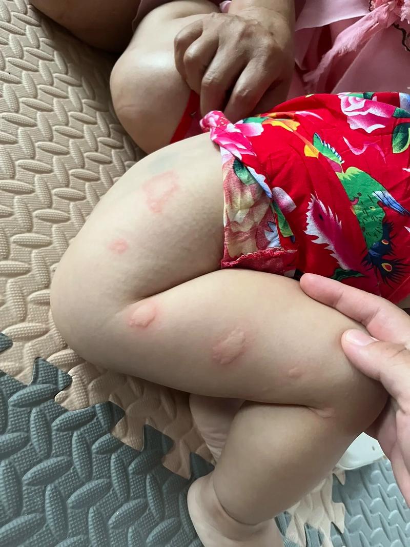 氨基酸奶粉
描述: 本文详细介绍了儿童过敏性鼻炎与食物过敏的关系，阐述了适合的特配奶粉类型、选择要点及食用注意事项，并分享实例，助力家长为患过敏性鼻炎的孩子选对奶粉，守护孩子健康成长 。