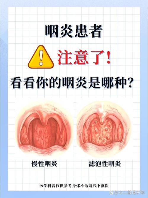 咽炎防治