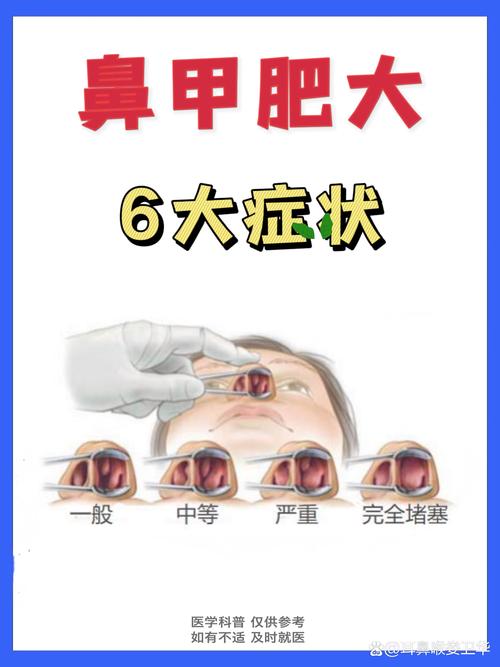 鼻甲肿大