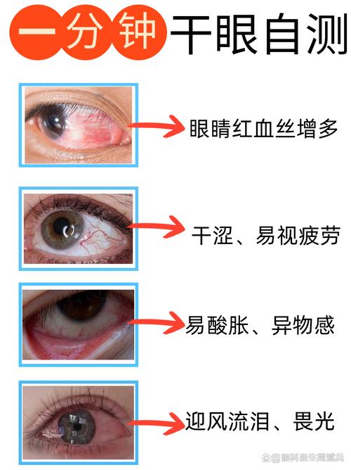 眼干症状