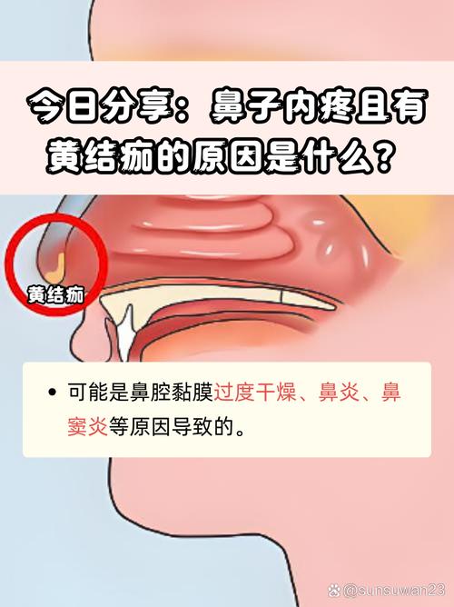 结痂鼻炎的正式名称是什么？